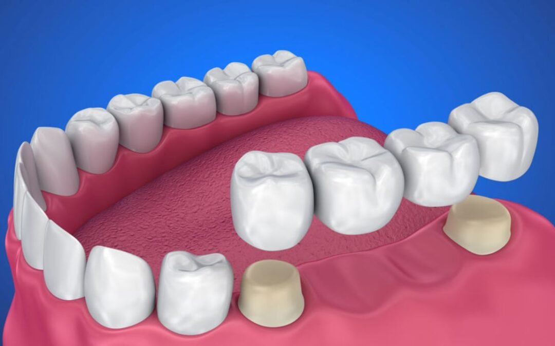 Can a Dental Bridge Be Removed and Recemented?