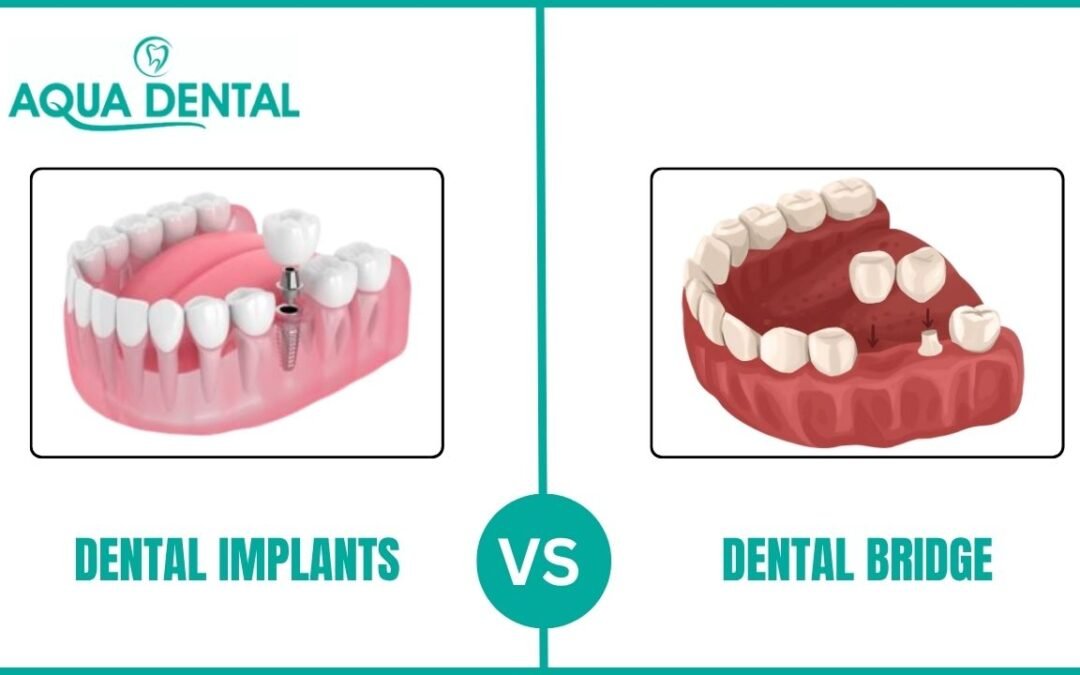 Dental Bridge vs Implant Cost