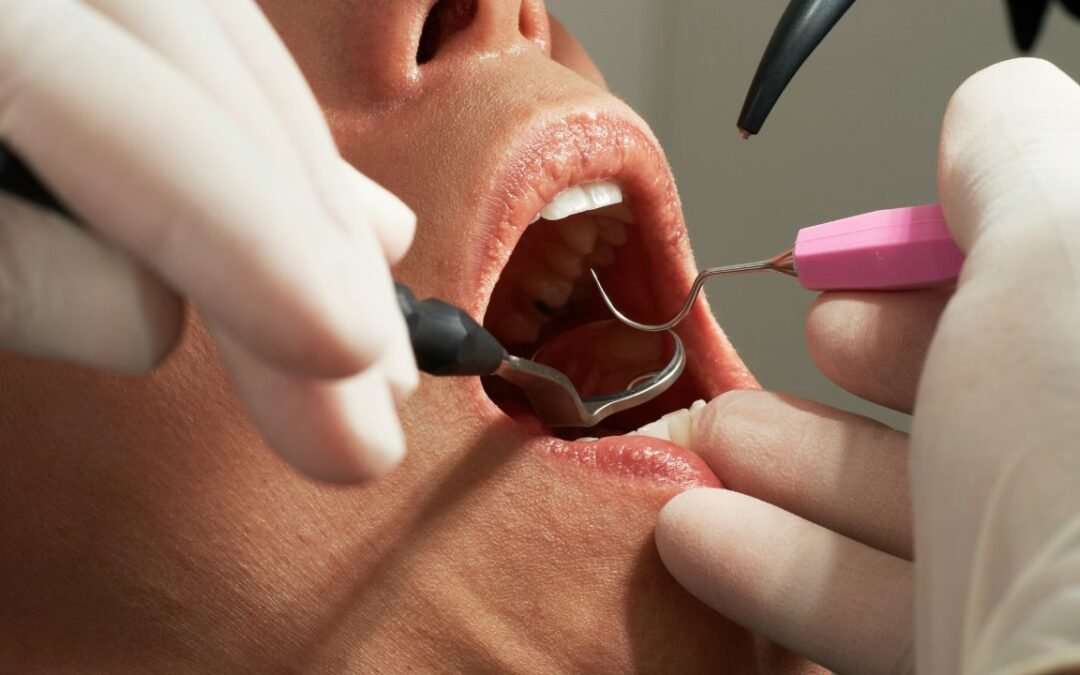 How Much Does Wisdom Teeth Removal Cost?