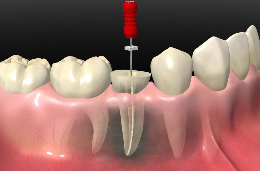 Root Canal Cost 2025: With & Without Insurance